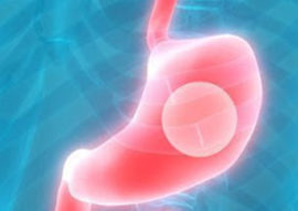 Intragastric Balloon