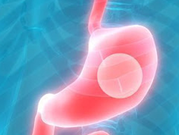 Intragastric Balloon